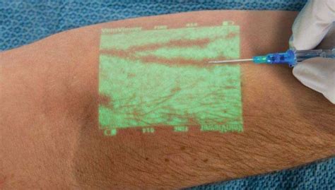 Veinviewer Creates Detailed Realtime Image Of Patients Veins