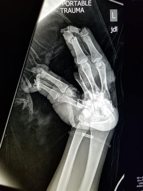20 Yo M Firecracker Exploded In Hand R Radiology