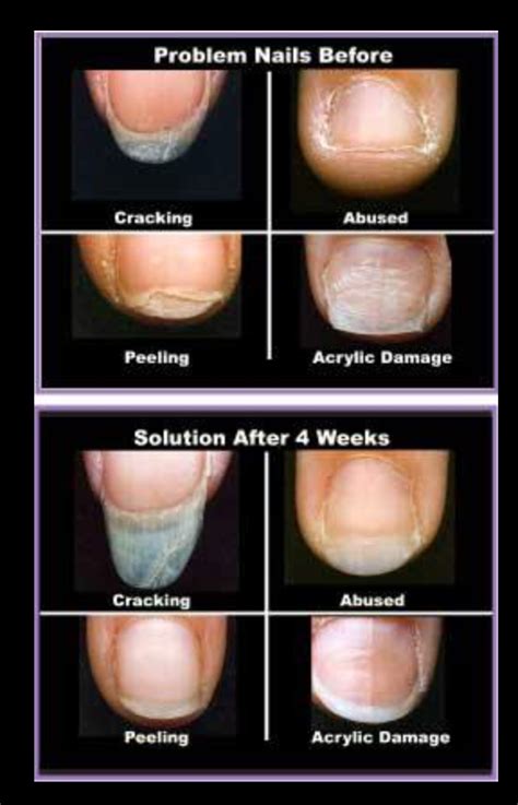 Hair, skin and nail problems that are caused by hypothyroidism can be reversed by treating hypothyroidism. Common nail problems and natural remedies: By Dr. Nima ...