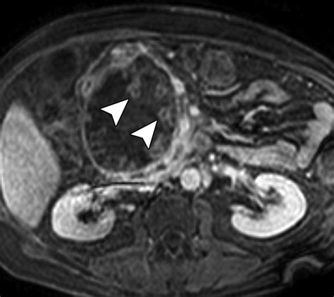 Mr Imaging Of Cystic Lesions Of The Pancreas Radiographics