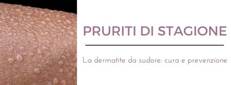Pruriti Di Stagione La Dermatite Da Sudore Prof Antonino Di Pietro