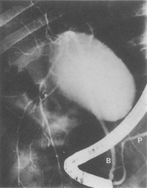 Ercp Showing The Pancreatic Duct P The Common Bile Duct B