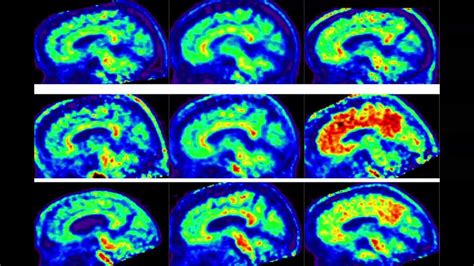 High Fat Foods Affect Brain Health Utd Researchers Necn