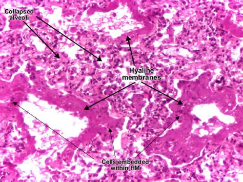 We did not find results for: Acute Respiratory Distress Syndrome (ARDS) - Respiratory ...