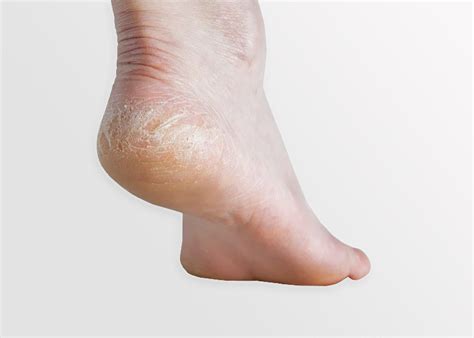 Dry Cracked Heels Prevent And Manage Florida Foot And Ankle