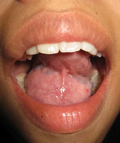 Photograph Showed Swelling At The Floor Of The Mouth The Wall