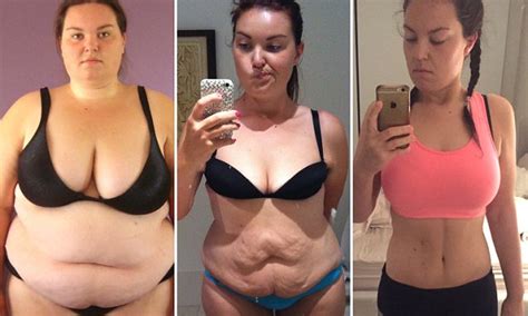 Woman Whose Stone Weight Loss Left Her With Boobs On Tummy Has Op To