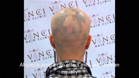 Treating Alopecia Areata Aka Spot Balding Using Scalp