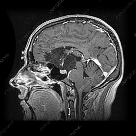 Intracranial Dermoid Cyst On Mri Stock Image C0432989 Science