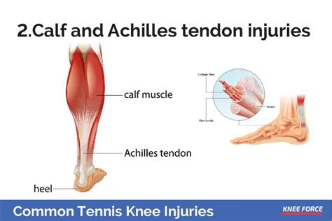 Front leg musclevtendon ~ anatomy stock images | lower leg. Common Tennis Knee Injuries and How To Prevent Them