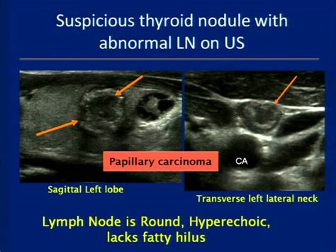 Abnormal Thyroid Cancer Ultrasound Colors Antoine Fry