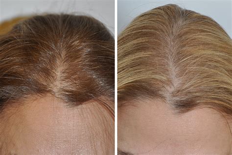 Hair Restoration Hair Transplant Surgery For Women In New York City