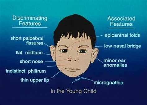 About Down Syndrome Anatomy And Physiology