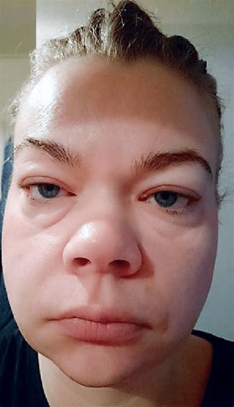 Fluid Retention Of The Face In A Patient With Idiopathic Edema