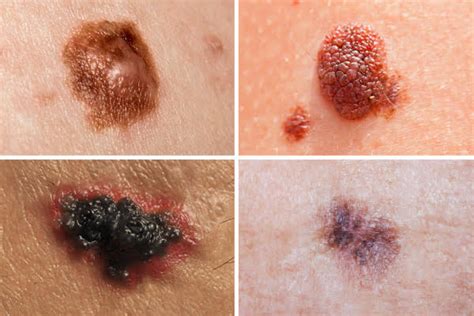 A Better Way To Distinguish Among Melanomas Contemporary Approaches