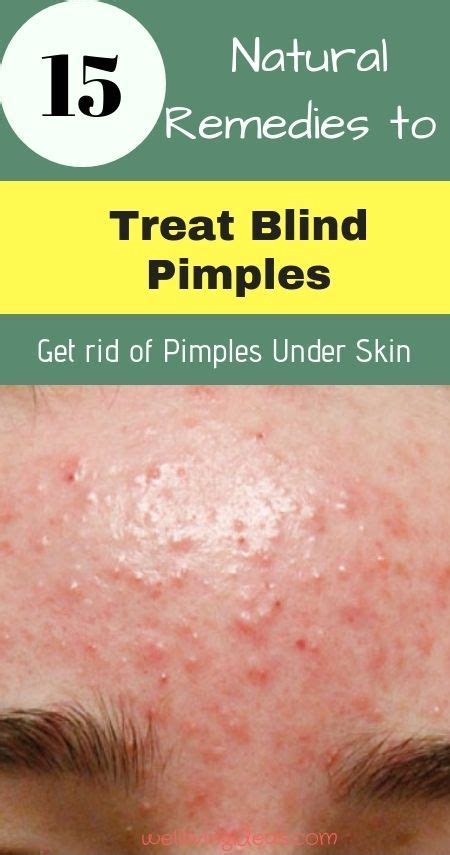 15 Home Remedies For Blind Pimple Under Skin Overnight Blind Pimple