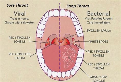 For some throat cancers, doctors can use newer drugs that starve the tumor. Sore Throat: Causes, Symptoms, & Remedies » How To Relief