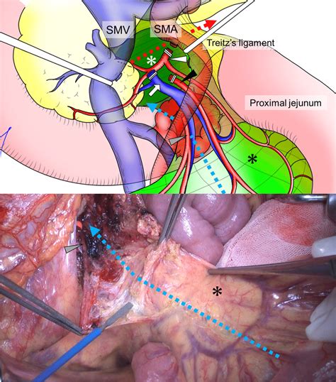 Ligament Of Treitz Anatomy Diagram