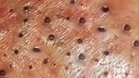 Blackheads Milia Big Cystic Acne Blackheads Extraction Whiteheads Removal Pimple Popping154