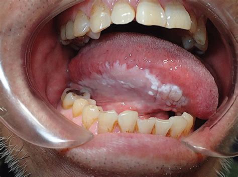 Leukoplakia Of The Tongue Cleveland Clinic Journal Of Medicine