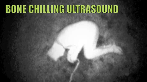 Bone Chilling Ultrasound Video Youtube