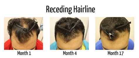 This is for guy who has receding hairline and wants to beat it! Jamaican Black Castor Oil for hairline? | Page 2 | Sports ...