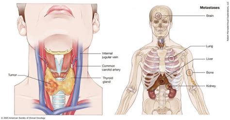 Ung thư tuyến giáp xảy ra khi có sự phát triển bất thường của các tế bào tuyến giáp. Ung thư tuyến giáp di căn phổi | TCI Hospital