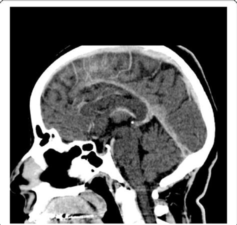 A Sagittal View Of The Computed Tomography Brain With Contrast Showing