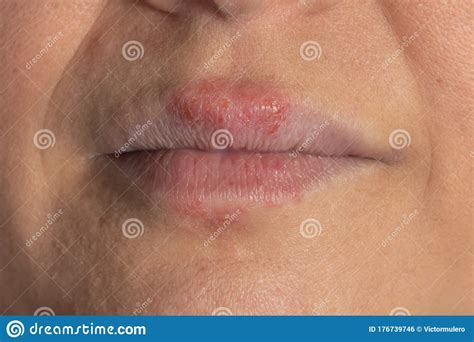 Allergic Reaction To Metal On The Lips Of A White Woman Stock Photo