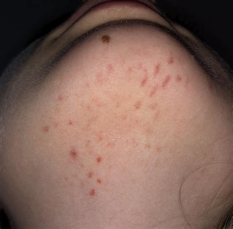 Small purple rash/ bruises caused by sertraline(Zoloft)? : SSRIs