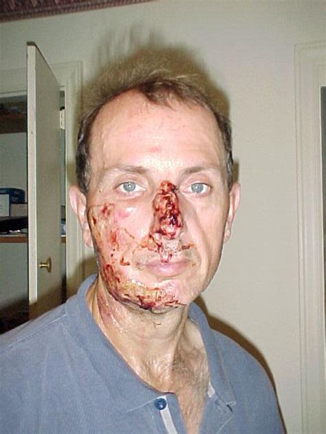 A common injury if you are thrown off your motorcycle is road rash. Road rash...do you remember your first? - bikejournal.com ...