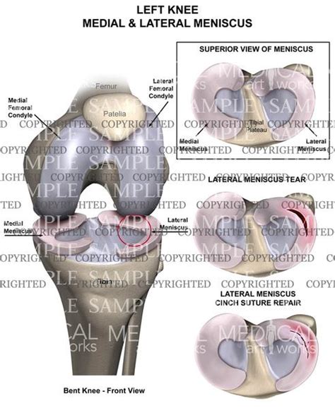 The meniscus is a type of cartilage in your knee joint. Left knee meniscus tear and repair — Medical Art Works