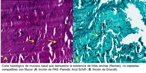 Juan camilo botero1, luis fernando moreno2, luis carlos. Mucormicosis rinocerebral fulminante. A propósito de un ...