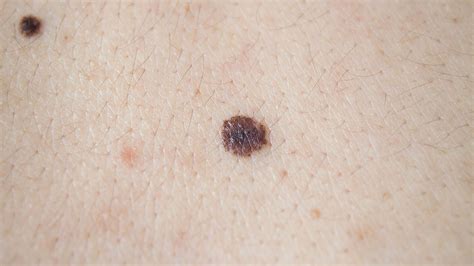 Melanoma Symptoms Causes Pictures Stages Signs And Symptoms Of My Xxx