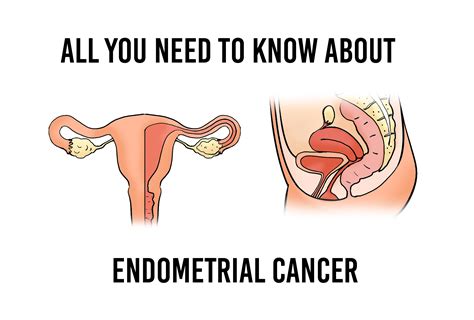 Endometrial cancer signs and symptoms. Endometrial Cancer: Symptoms, Causes, and Prevention ...