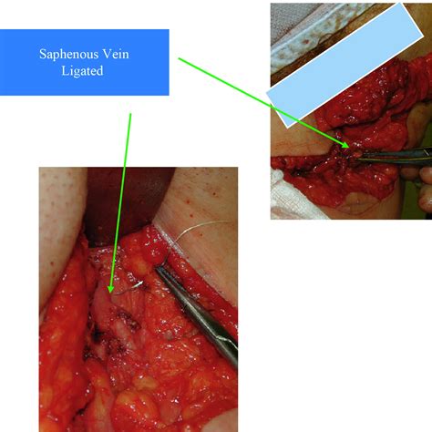 Minimal Access Inguinal Lymphadenectomy A Modified Technique Of Groin
