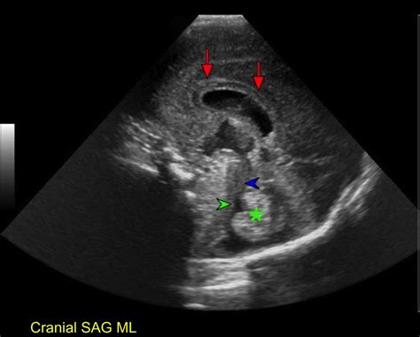 Normal Neonatal Brain Sonography Of A Preterm Newborn In Sagittal