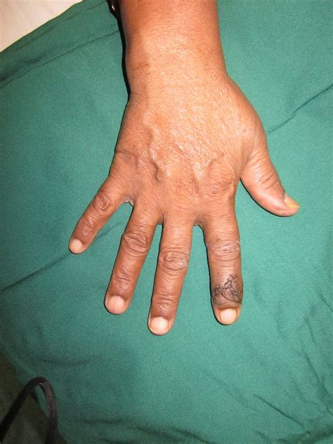 Crush Injuries Of Hand And Upper Limb Injuries Hand Tumor Giant Cell