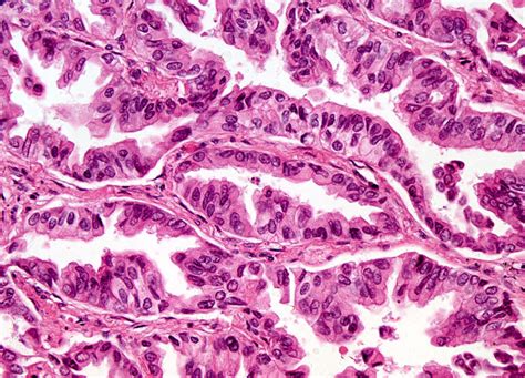 Check spelling or type a new query. Alveolar Cell Carcinoma at 20x Magnification | Nikon's ...