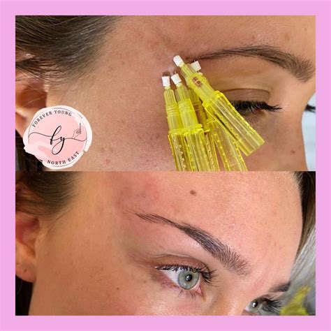 Definitive guide on pdo thread lift, including the procedure overview, benefits, risks, recovery, before & after photos, costs, and more. The Cateye brow lift using PDO Threads ... - Forever Young ...