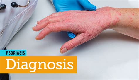 Psoriasis The Path To Diagnosis Mypsoriasisteam