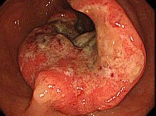 大腸癌の化学療法 q12 大腸癌に効く新しい抗がん剤があると聞きました。 どのような薬ですか？ 大腸癌の補助化学療法 q13 手術で取ったリンパ節に転移が見つかり，抗がん剤治療を奨められました。 大腸がんの初期症状は【おなら？便秘？】 - 【麻酔の大腸検査 ...