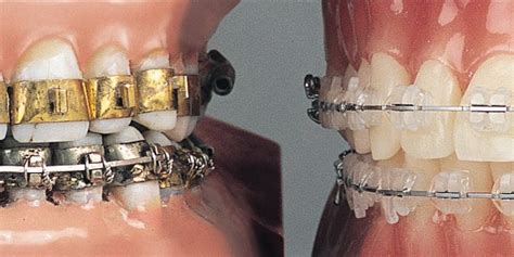 The History Of Braces Weber Orthodontics Kansas City