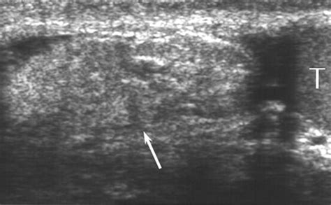 Sonographic Findings Of Groin Masses Yang 2007 Journal Of