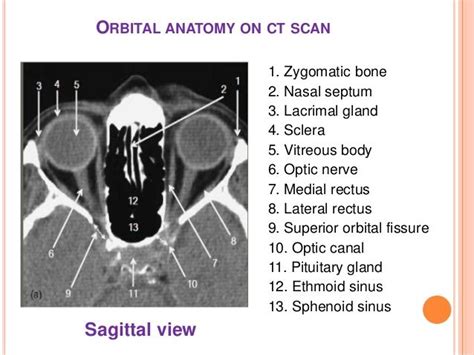 Image Result For Ct Scan Eyes Orbit Anatomy Ct Scan Anatomy