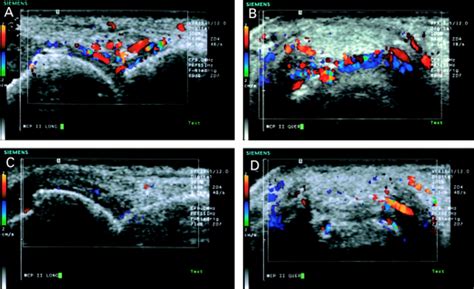 High Resolution Ultrasound Detects A Decrease In Pannus Vascularisation