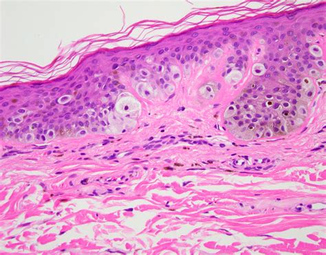 Pathology Outlines Dysplastic Nevus