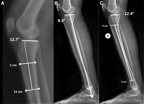 Posterior Tibial Slope Measurements Using The Anatomic Axis Are