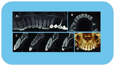 MPR is very useful in evaluating dentoalveolar fractures ...