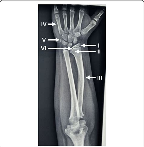 Radiological Features In Shox Deficiency I Triangularization Of The